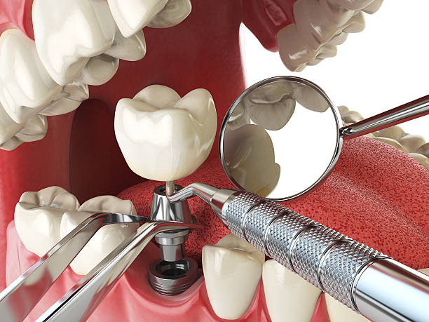 Best Emergency Broken Tooth Repair in Somerset, KY
